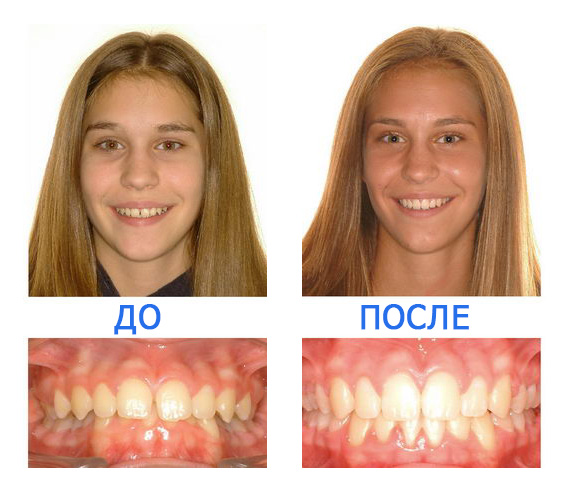 Исправление зубов брекетами фото до и после
