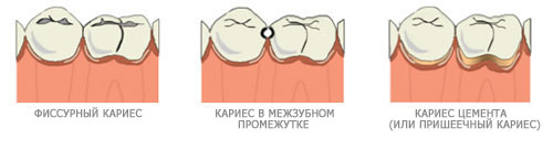 Виды кариеса зубов с картинками